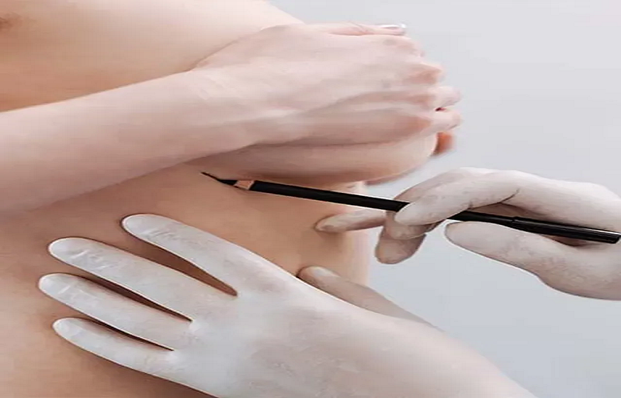 breast reconstruction Roslyn Heights