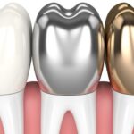 Dental Crowns: Why You Need Them and What to Expect?