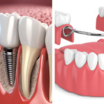 Dentures for People with Bone Loss