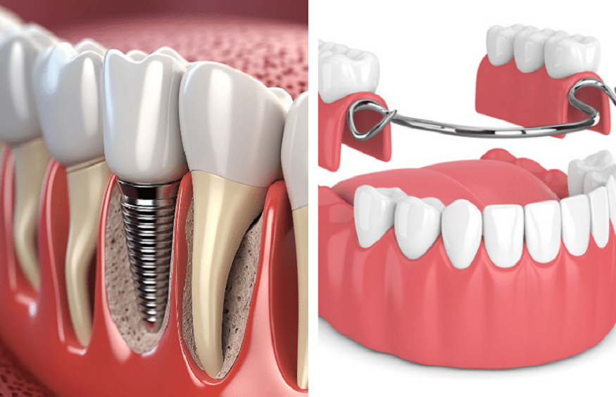 Dentures for People with Bone Loss