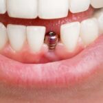 The Complete Redlands, CA Guide to Dental Implant Surgery