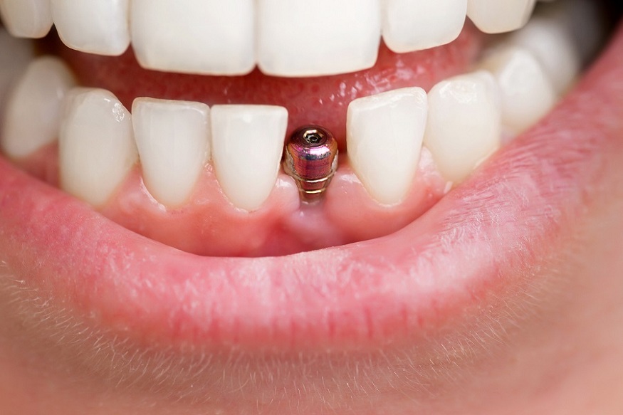 Dental Implant Surgery