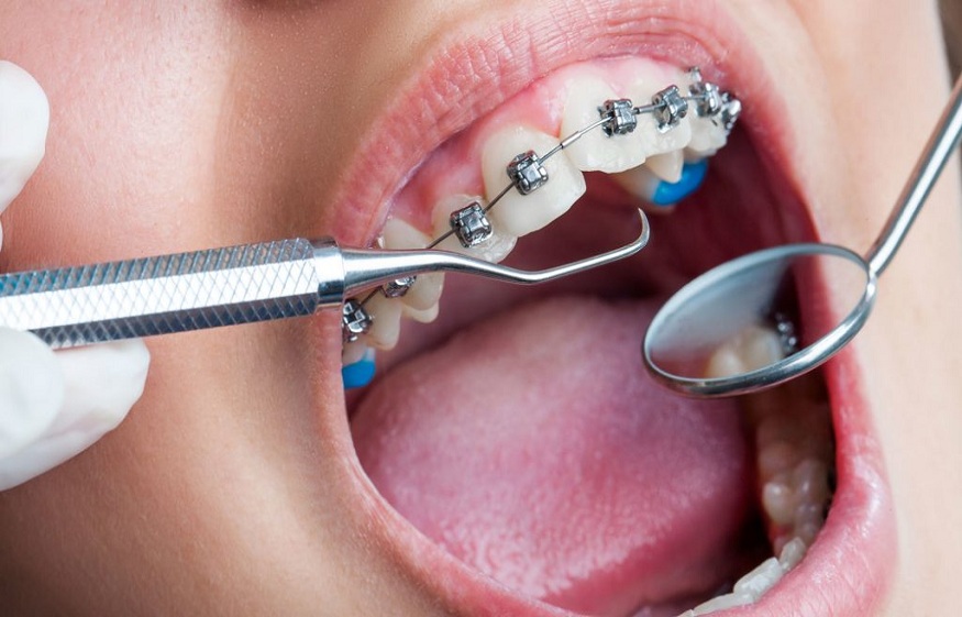 Orthodontic Appliances