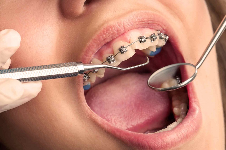 Orthodontic Treatment