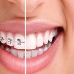 The Importance of Retention Phase in Orthodontics: Maintaining Your New Smile