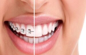 The Importance of Retention Phase in Orthodontics: Maintaining Your New Smile